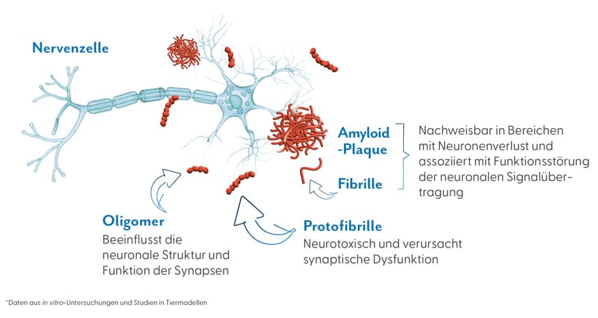 Darstellung einer Nervenzelle mit Beta-Amyloid-Ablagerungen, die synaptische Dysfunktion und Neuronenverlust verursachen.